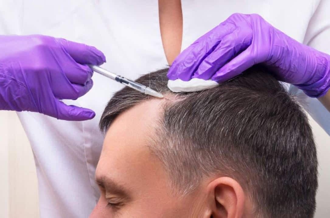 Haartransplantation türkei Kosten: Was Sie erwarten können