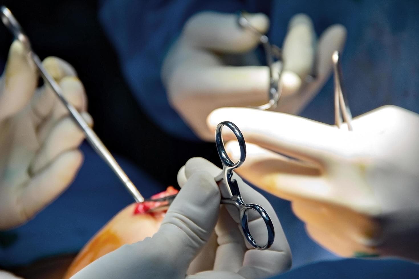 Brustvergrößerung mit Implantaten: Individuelle Beratung und maßgeschneiderte Lösungen